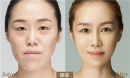 切開(kāi)雙眼皮怎么做的??