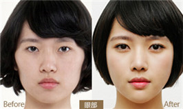 內(nèi)眼角手術(shù)前后對(duì)比圖?