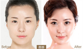 下頜角整形對(duì)比圖?